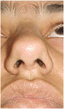 boxer tip nose treatment in chandigarh, punjab