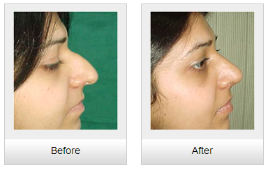 nose job in chandigarh