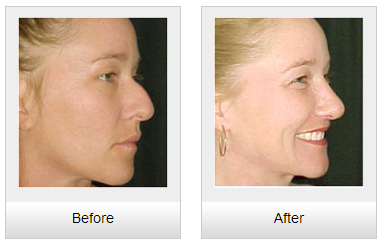 nose reshaping in chandigarh