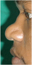 depressed nose treatment in chandigarh, punjab