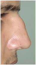 hump nose treatment in chandigarh, punjab