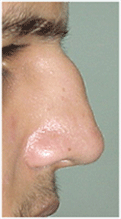 rhinoplasty in punjab